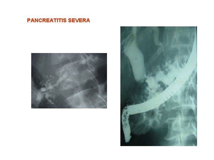 PANCREATITIS SEVERA 