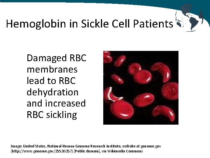 Hemoglobin in Sickle Cell Patients Damaged RBC membranes lead to RBC dehydration and increased