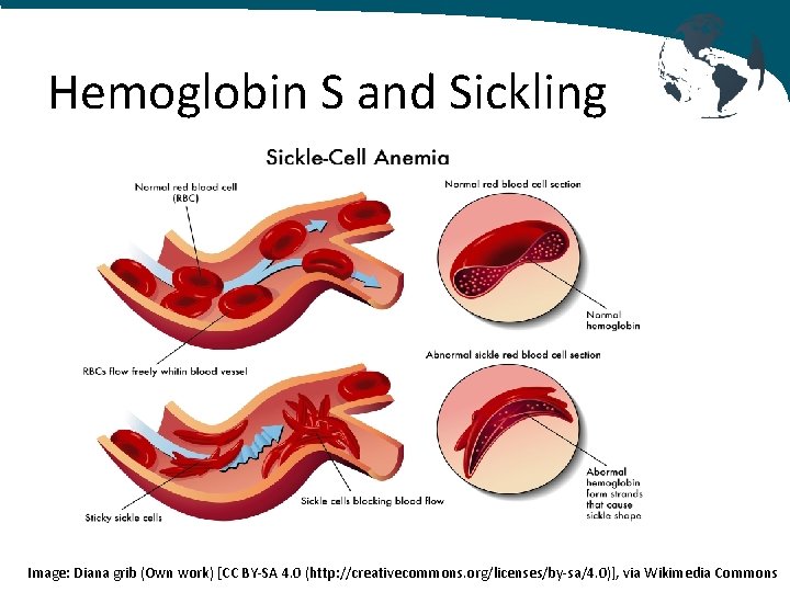 Hemoglobin S and Sickling Image: Diana grib (Own work) [CC BY-SA 4. 0 (http: