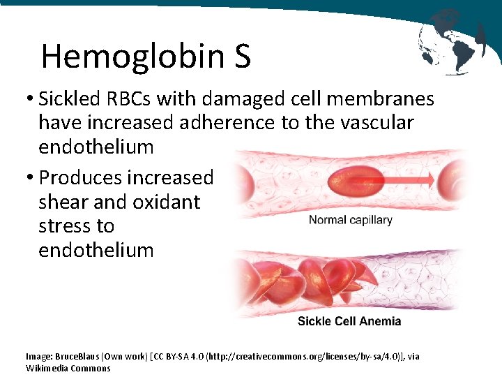 Hemoglobin S • Sickled RBCs with damaged cell membranes have increased adherence to the