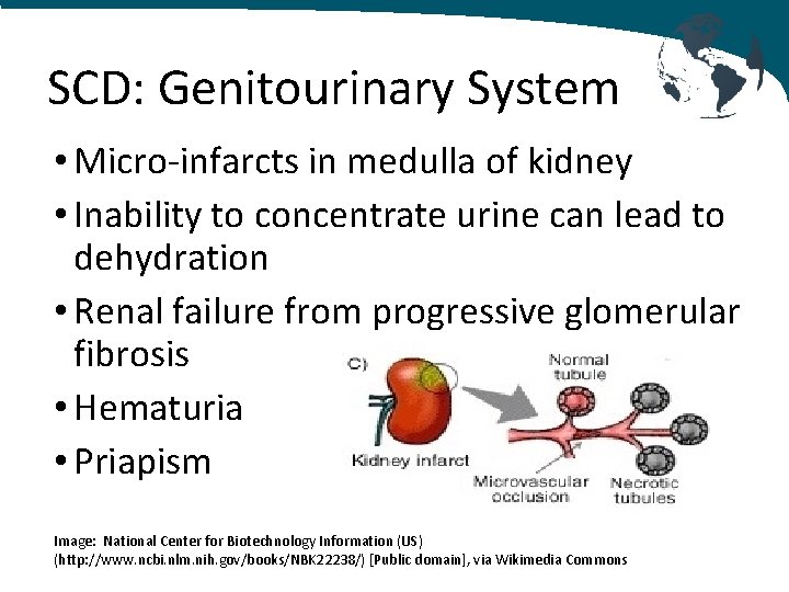 SCD: Genitourinary System • Micro-infarcts in medulla of kidney • Inability to concentrate urine