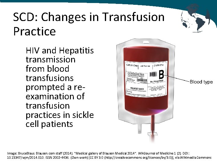 SCD: Changes in Transfusion Practice HIV and Hepatitis transmission from blood transfusions prompted a