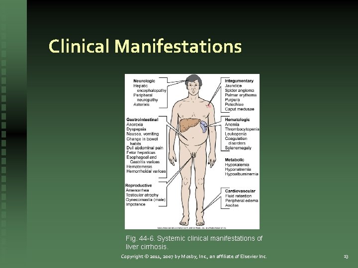 Clinical Manifestations Fig. 44 -6. Systemic clinical manifestations of liver cirrhosis. Copyright © 2011,