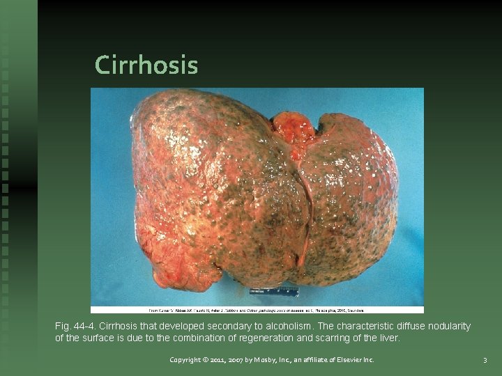 Cirrhosis Fig. 44 -4. Cirrhosis that developed secondary to alcoholism. The characteristic diffuse nodularity