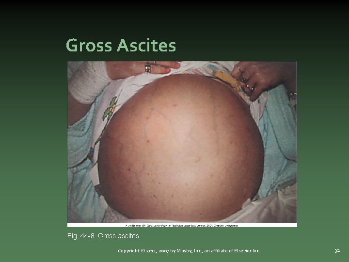 Gross Ascites Fig. 44 -8. Gross ascites. Copyright © 2011, 2007 by Mosby, Inc.