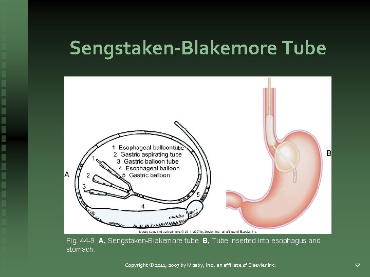 Sengstaken-Blakemore Tube Fig. 44 -9. A, Sengstaken-Blakemore tube. B, Tube inserted into esophagus and