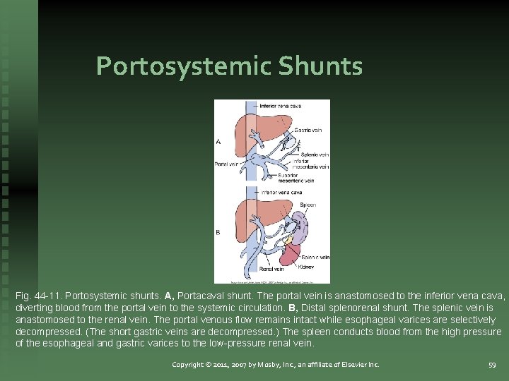 Portosystemic Shunts Fig. 44 -11. Portosystemic shunts. A, Portacaval shunt. The portal vein is