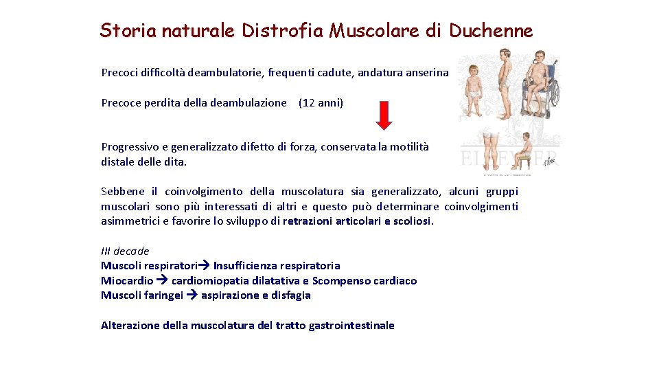 Storia naturale Distrofia Muscolare di Duchenne Precoci difficoltà deambulatorie, frequenti cadute, andatura anserina Precoce