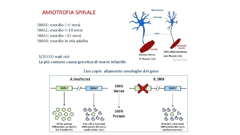 AMIOTROFIA SPINALE SMA 1: esordio 0 -6 mesi SMA 2: esordio 6 -18 mesi