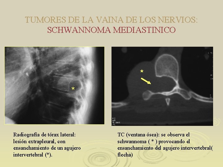 TUMORES DE LA VAINA DE LOS NERVIOS: SCHWANNOMA MEDIASTINICO * * Radiografía de tórax