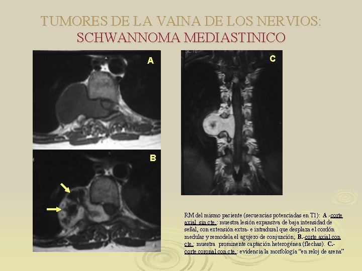 TUMORES DE LA VAINA DE LOS NERVIOS: SCHWANNOMA MEDIASTINICO A C B RM del