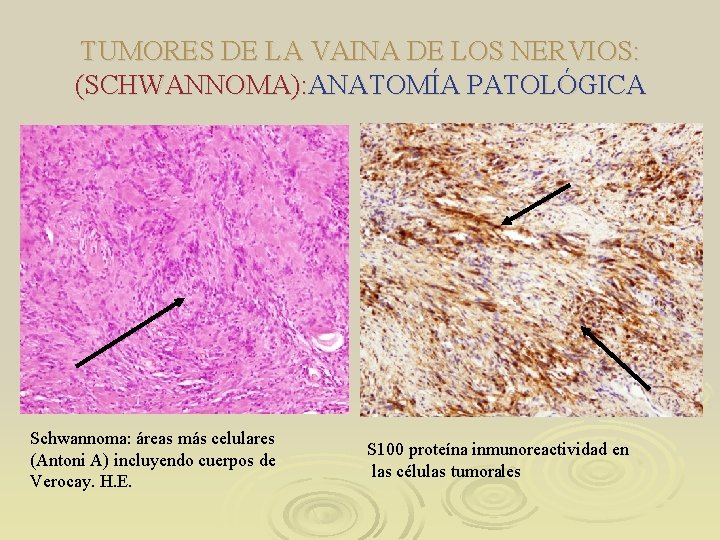 TUMORES DE LA VAINA DE LOS NERVIOS: (SCHWANNOMA): ANATOMÍA PATOLÓGICA Schwannoma: áreas más celulares TUMORES DE LA VAINA DE LOS NERVIOS: (SCHWANNOMA): ANATOMÍA PATOLÓGICA Schwannoma: áreas más celulares