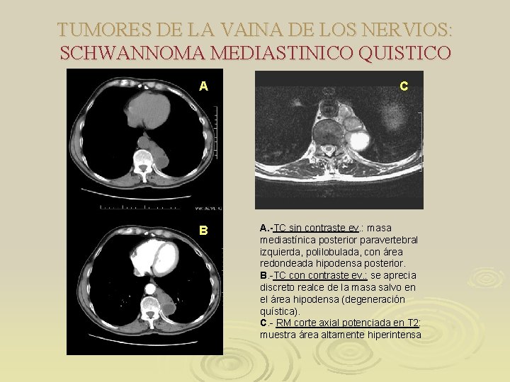 TUMORES DE LA VAINA DE LOS NERVIOS: SCHWANNOMA MEDIASTINICO QUISTICO A B C A.