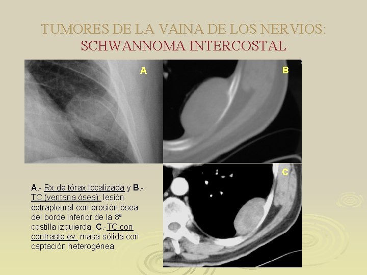 TUMORES DE LA VAINA DE LOS NERVIOS: SCHWANNOMA INTERCOSTAL A B C A. - TUMORES DE LA VAINA DE LOS NERVIOS: SCHWANNOMA INTERCOSTAL A B C A. -
