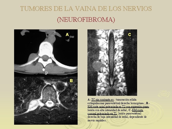 TUMORES DE LA VAINA DE LOS NERVIOS (NEUROFIBROMA) A C B A. -TC sin