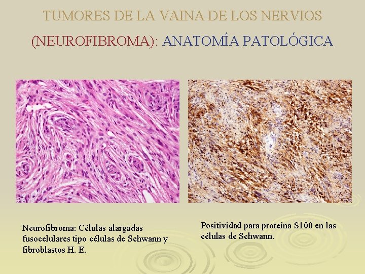 TUMORES DE LA VAINA DE LOS NERVIOS (NEUROFIBROMA): ANATOMÍA PATOLÓGICA Neurofibroma: Células alargadas fusocelulares