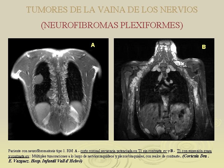 TUMORES DE LA VAINA DE LOS NERVIOS (NEUROFIBROMAS PLEXIFORMES) A B Paciente con neurofibromatosis