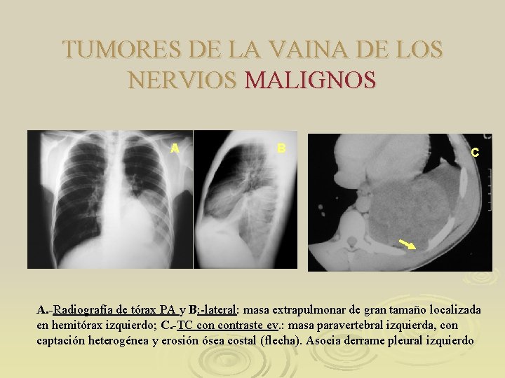 TUMORES DE LA VAINA DE LOS NERVIOS MALIGNOS A B C A. -Radiografía de TUMORES DE LA VAINA DE LOS NERVIOS MALIGNOS A B C A. -Radiografía de