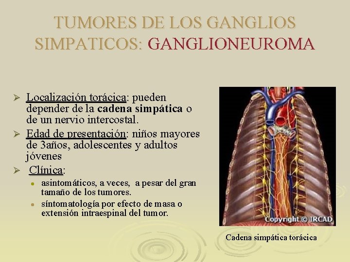 TUMORES DE LOS GANGLIOS SIMPATICOS: GANGLIONEUROMA Localización torácica: pueden depender de la cadena simpática TUMORES DE LOS GANGLIOS SIMPATICOS: GANGLIONEUROMA Localización torácica: pueden depender de la cadena simpática