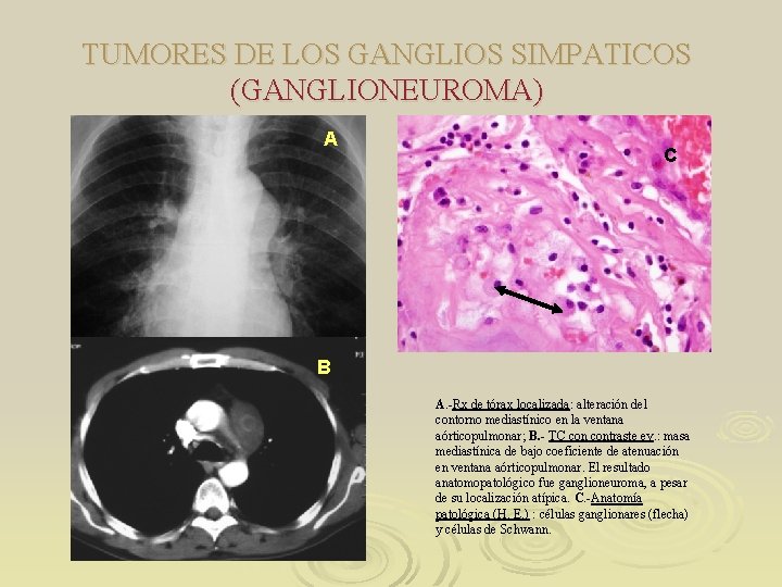TUMORES DE LOS GANGLIOS SIMPATICOS (GANGLIONEUROMA) A C B A. -Rx de tórax localizada: