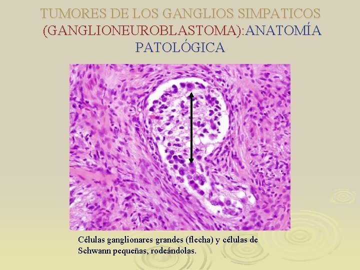 TUMORES DE LOS GANGLIOS SIMPATICOS (GANGLIONEUROBLASTOMA): ANATOMÍA PATOLÓGICA Células ganglionares grandes (flecha) y células TUMORES DE LOS GANGLIOS SIMPATICOS (GANGLIONEUROBLASTOMA): ANATOMÍA PATOLÓGICA Células ganglionares grandes (flecha) y células