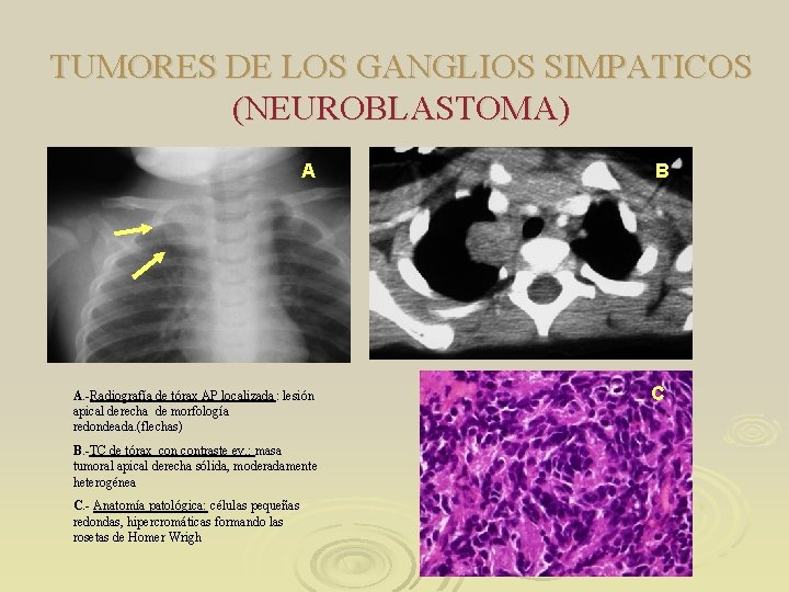 TUMORES DE LOS GANGLIOS SIMPATICOS (NEUROBLASTOMA) A A. -Radiografía de tórax AP localizada: lesión