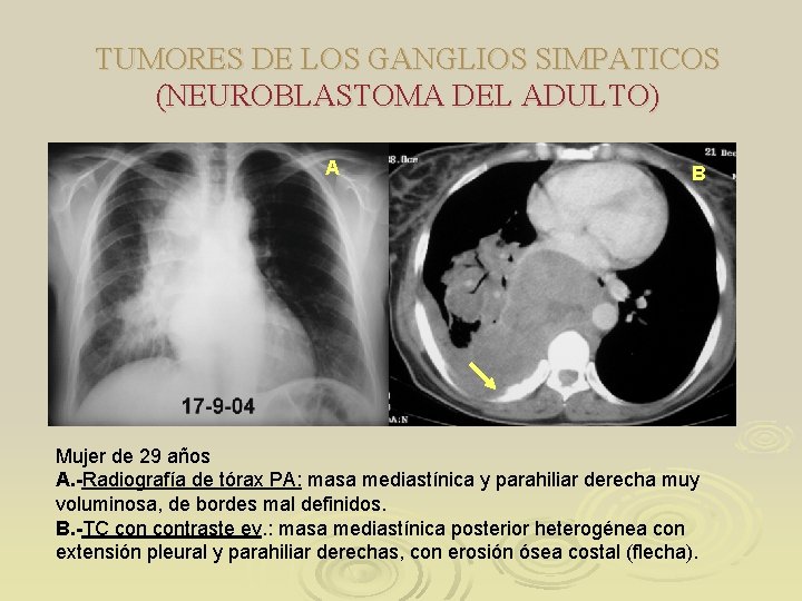 TUMORES DE LOS GANGLIOS SIMPATICOS (NEUROBLASTOMA DEL ADULTO) A B Mujer de 29 años