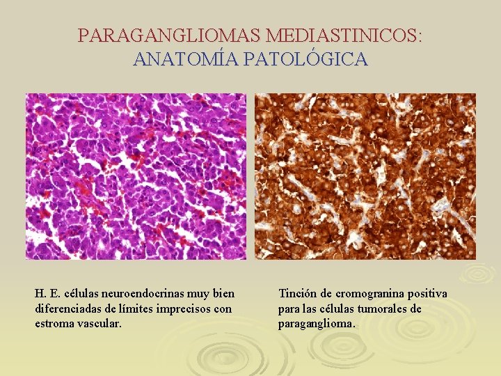 PARAGANGLIOMAS MEDIASTINICOS: ANATOMÍA PATOLÓGICA H. E. células neuroendocrinas muy bien diferenciadas de límites imprecisos