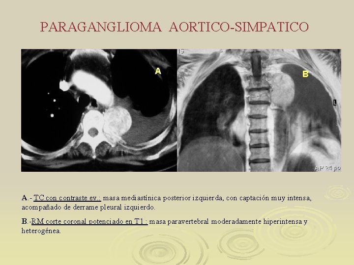 PARAGANGLIOMA AORTICO-SIMPATICO A B A. - TC contraste ev. : masa mediastínica posterior izquierda,