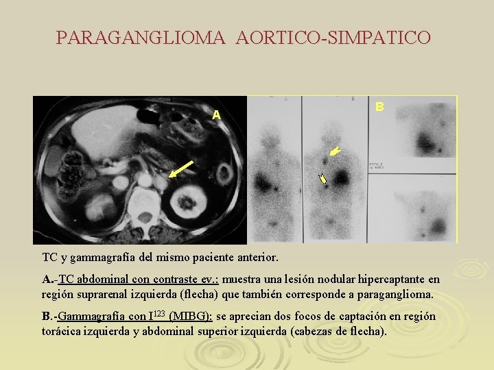 PARAGANGLIOMA AORTICO-SIMPATICO A B TC y gammagrafía del mismo paciente anterior. A. -TC abdominal