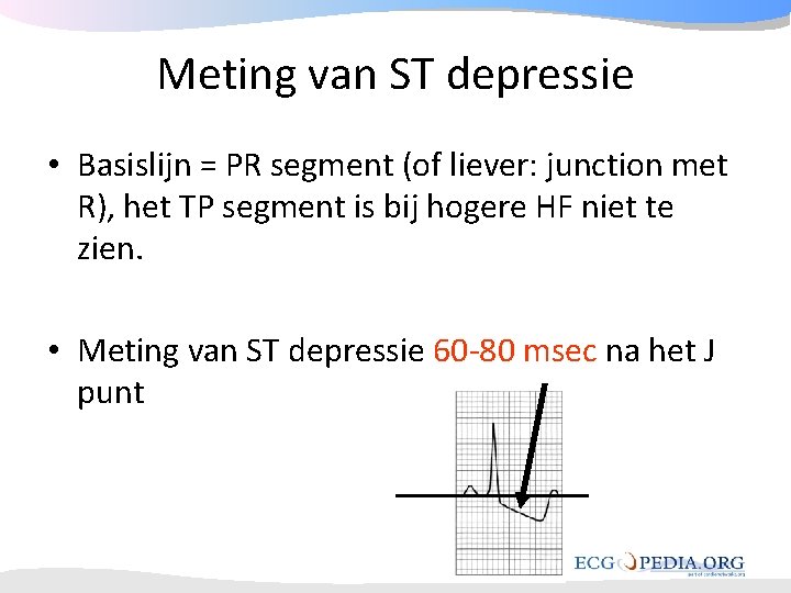 Meting van ST depressie • Basislijn = PR segment (of liever: junction met R), Meting van ST depressie • Basislijn = PR segment (of liever: junction met R),