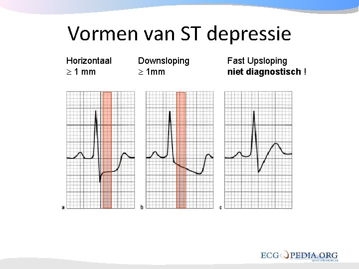 Vormen van ST depressie Horizontaal 1 mm Downsloping 1 mm Fast Upsloping niet diagnostisch Vormen van ST depressie Horizontaal 1 mm Downsloping 1 mm Fast Upsloping niet diagnostisch