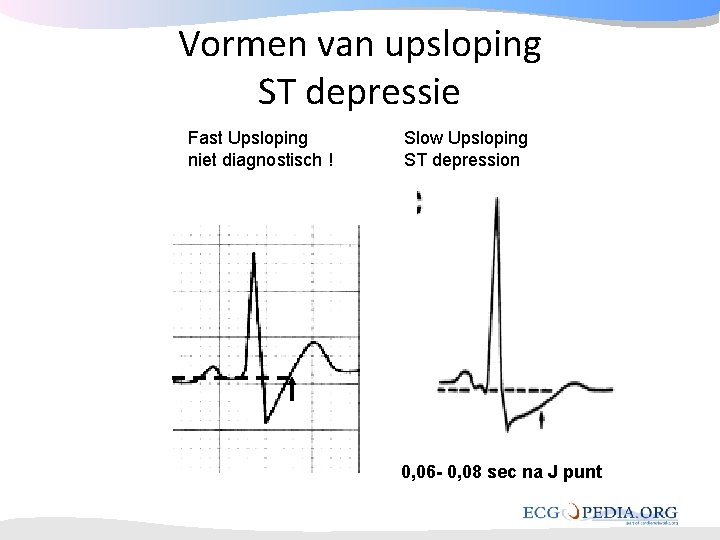 Vormen van upsloping ST depressie Fast Upsloping niet diagnostisch ! Slow Upsloping ST depression Vormen van upsloping ST depressie Fast Upsloping niet diagnostisch ! Slow Upsloping ST depression