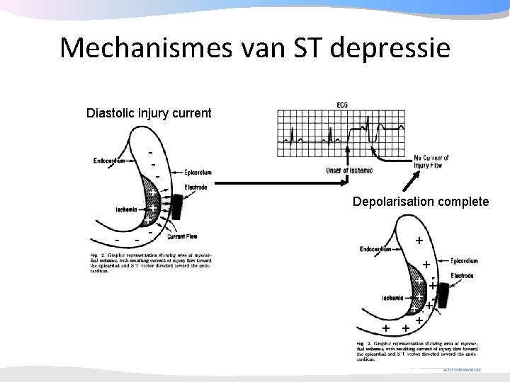 Mechanismes van ST depressie Diastolic injury current - - + + + - Depolarisation Mechanismes van ST depressie Diastolic injury current - - + + + - Depolarisation