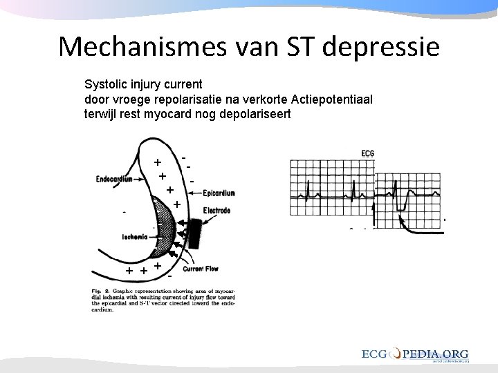 Mechanismes van ST depressie Systolic injury current door vroege repolarisatie na verkorte Actiepotentiaal terwijl Mechanismes van ST depressie Systolic injury current door vroege repolarisatie na verkorte Actiepotentiaal terwijl
