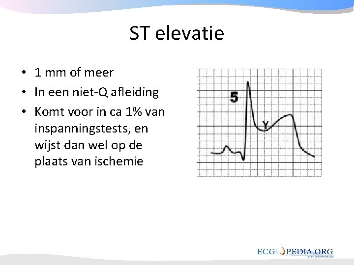 ST elevatie • 1 mm of meer • In een niet-Q afleiding • Komt ST elevatie • 1 mm of meer • In een niet-Q afleiding • Komt
