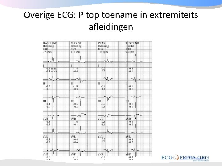 Overige ECG: P top toename in extremiteits afleidingen Overige ECG: P top toename in extremiteits afleidingen