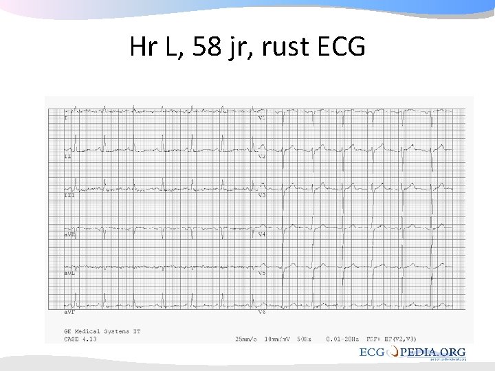 Hr L, 58 jr, rust ECG Hr L, 58 jr, rust ECG