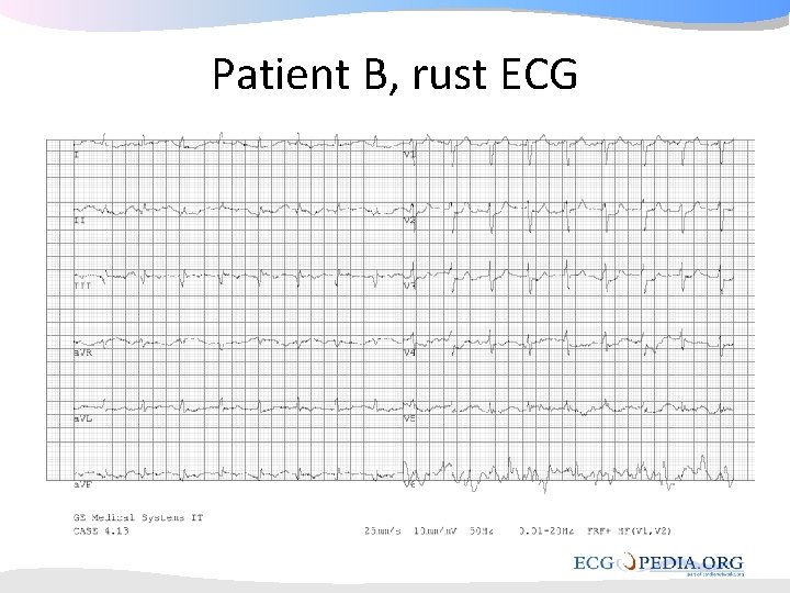 Patient B, rust ECG Patient B, rust ECG