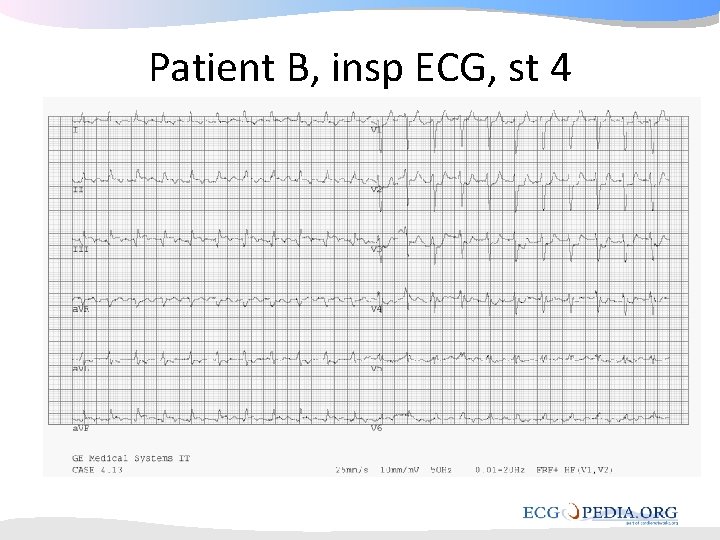 Patient B, insp ECG, st 4 Patient B, insp ECG, st 4