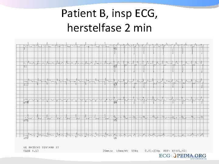 Patient B, insp ECG, herstelfase 2 min Patient B, insp ECG, herstelfase 2 min