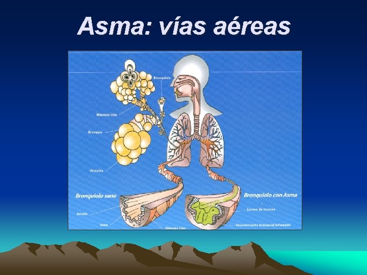 Asma: vías aéreas 