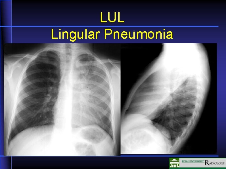 LUL Lingular Pneumonia 