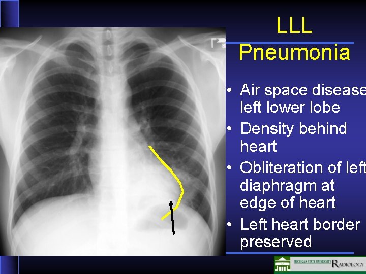 LLL Pneumonia • Air space disease left lower lobe • Density behind heart •