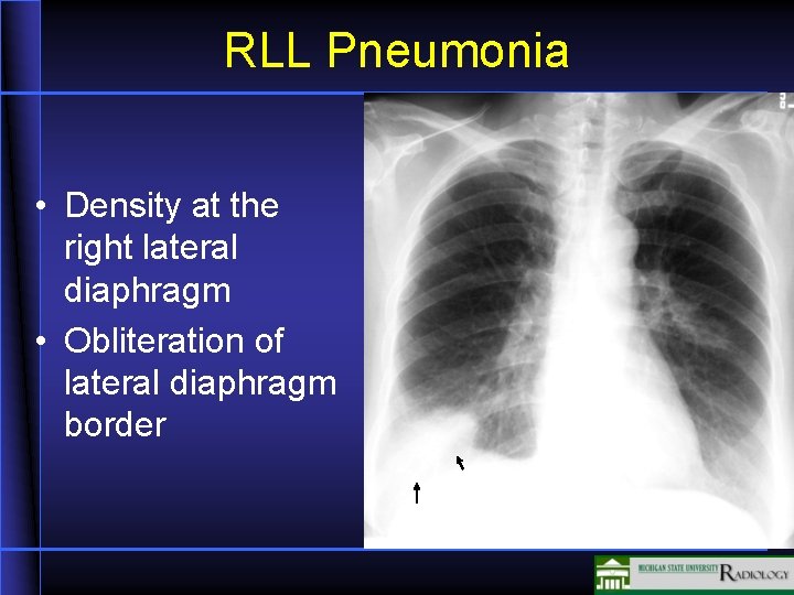 RLL Pneumonia • Density at the right lateral diaphragm • Obliteration of lateral diaphragm