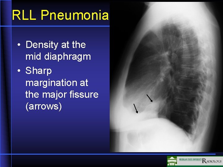 RLL Pneumonia • Density at the mid diaphragm • Sharp margination at the major