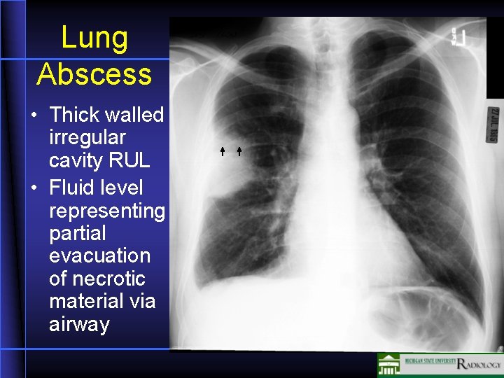 Lung Abscess • Thick walled irregular cavity RUL • Fluid level representing partial evacuation