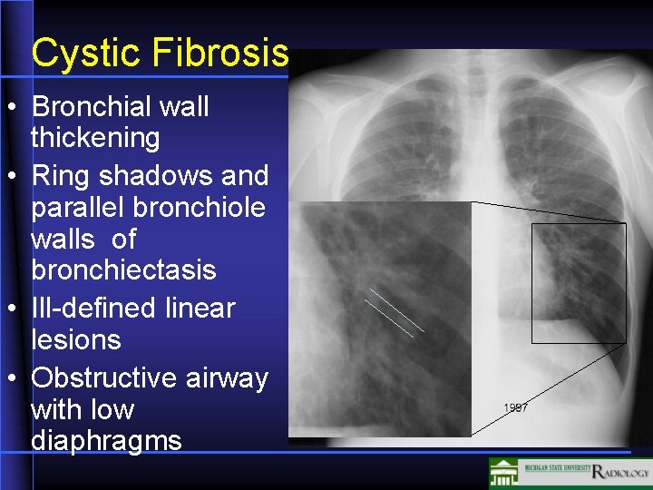 Cystic Fibrosis • Bronchial wall thickening • Ring shadows and parallel bronchiole walls of