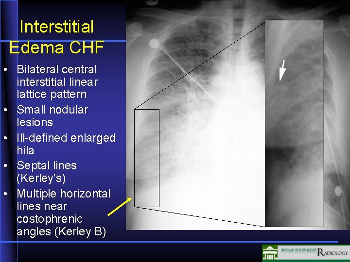 Interstitial Edema CHF • Bilateral central interstitial linear lattice pattern • Small nodular lesions