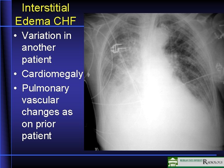 Interstitial Edema CHF • Variation in another patient • Cardiomegaly • Pulmonary vascular changes